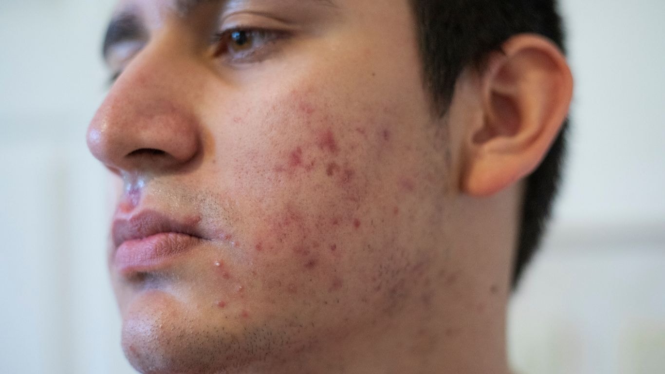 Does THC Cause Acne? Here’s What Science Really Says